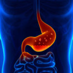Is Your Body Suffering from Low Stomach Acid?