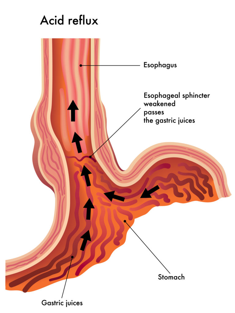 Seven Easy Ways to Resolve Acid Reflux Naturally Lasting Change Health Root Cause of Acid Reflux