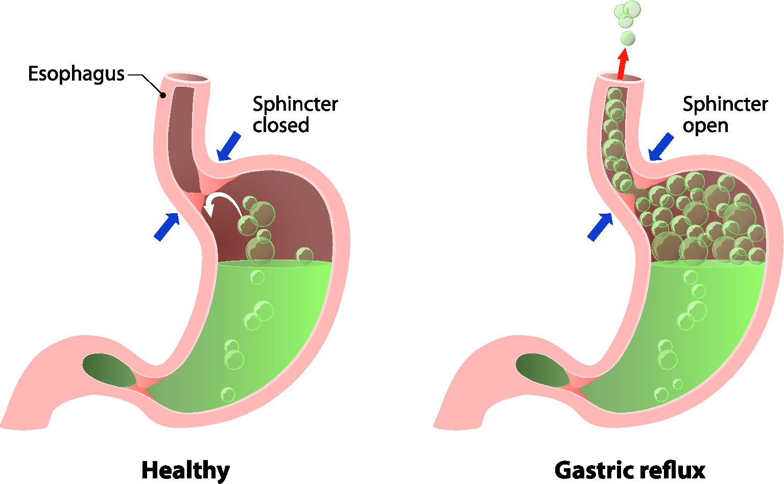 Can Reflux Cause Chest And Back Pain